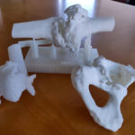 L’hospital de Palamós comença a fer servir reproduccions en 3D per a cirurgies complexes hospital de palamós 3d