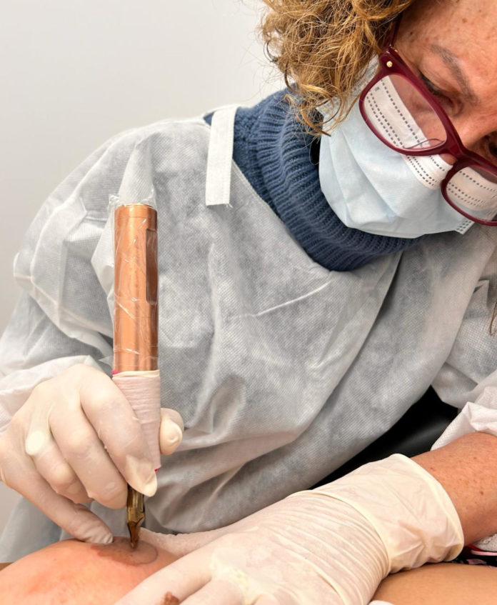Una professional d'infermeria de l'hospital de Palamós practica una micropigmentació de mugró a una pacient Data de publicació: dijous 23 de maig del 2024, 11:55 Localització: Palamós Autor: Imatge cedida a l'ACN per l'Hospital de Palamós